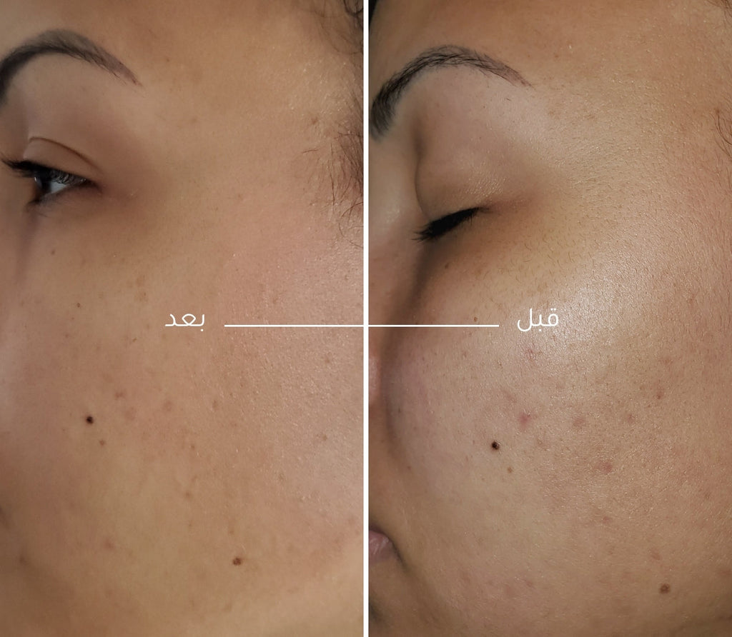 tara_pdp_purifybefore_after_ar.jpg